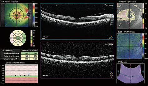 retinal thickness measurement oct